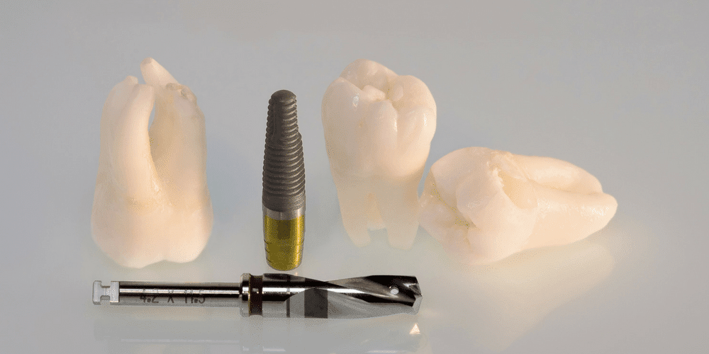 Too Much Loss for Dental Implants? Bone Grafts may be a Solution