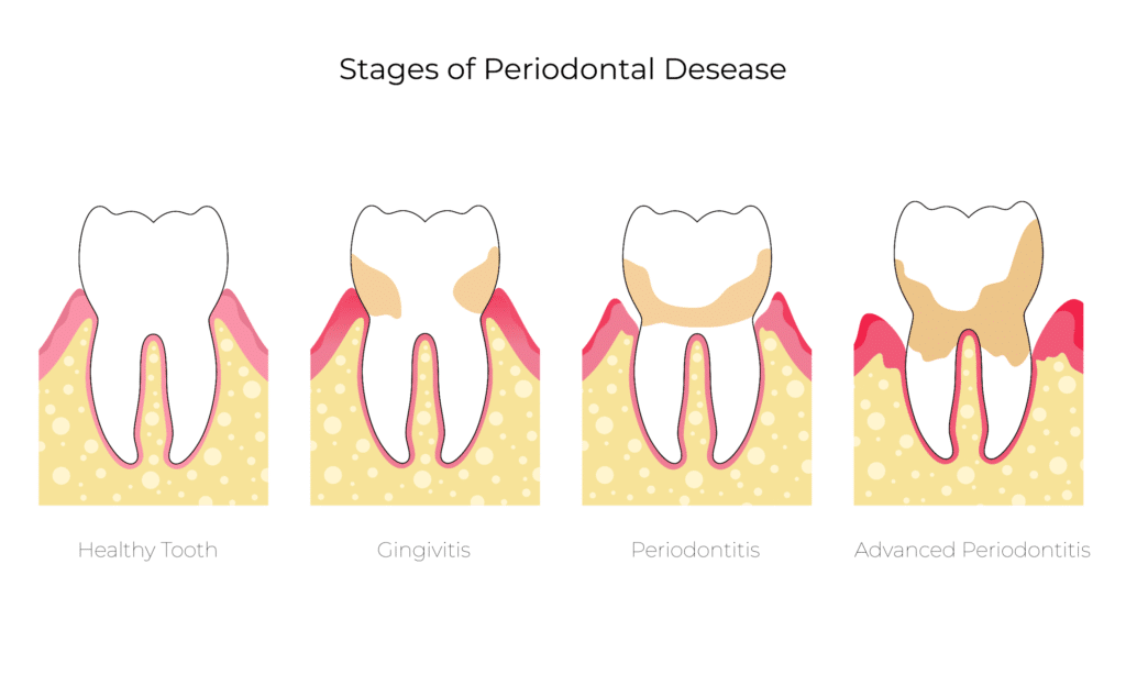 Stages of Periodontitis