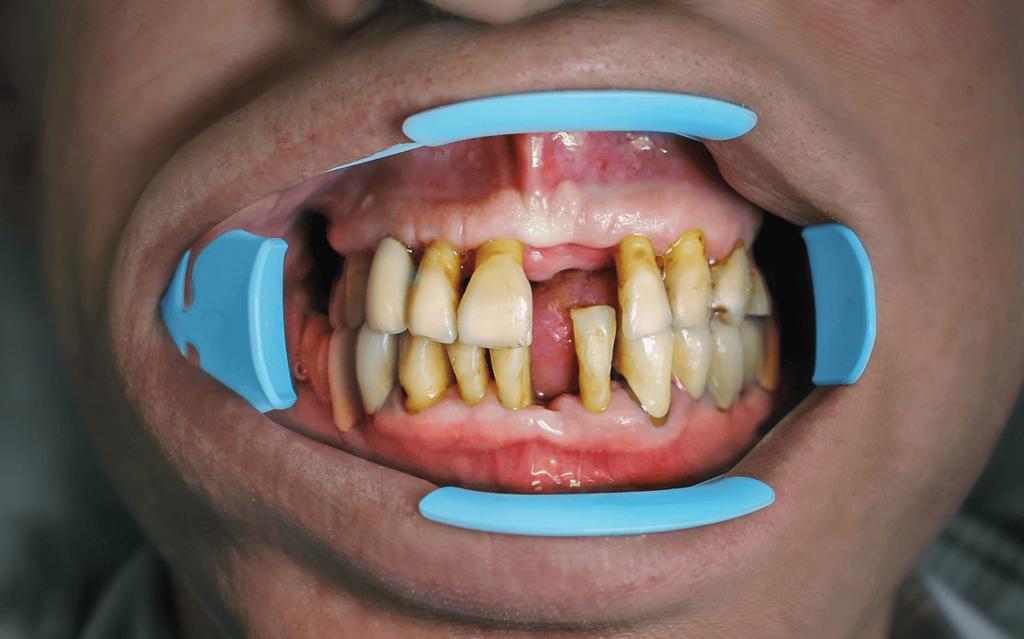 When Is It Too Late for Gum Grafting?