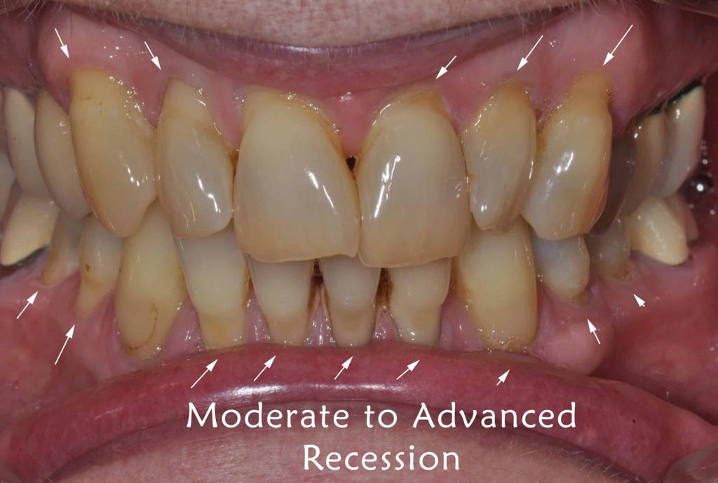 Receding Gums Stages