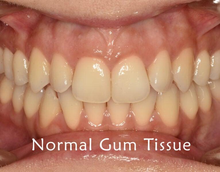 Normal gums example