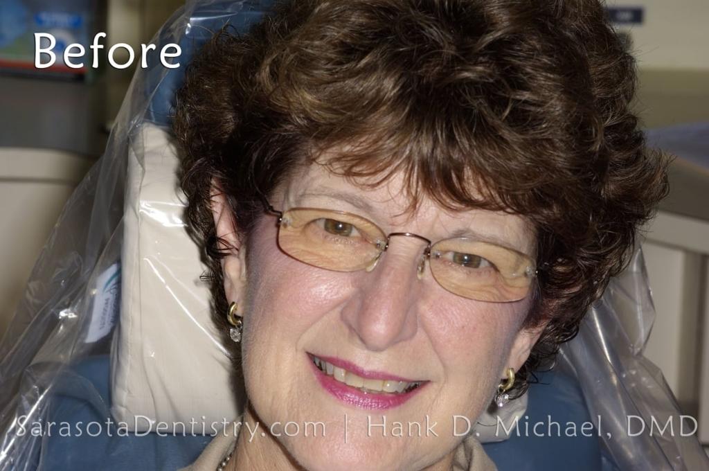 Porcelain Crown Smile Makeover #2 — view 2
