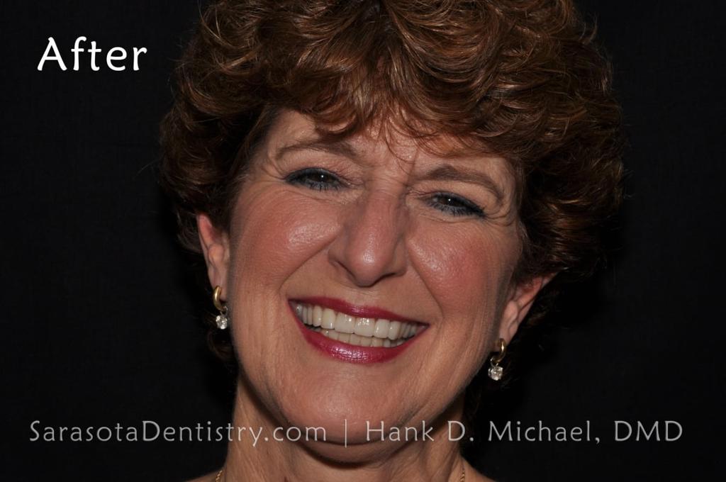 Porcelain Crown Smile Makeover #2 — view 1