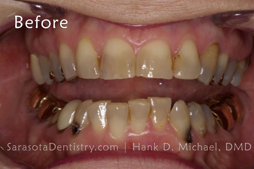 Porcelain Crown Smile Makeover #2 — view 4