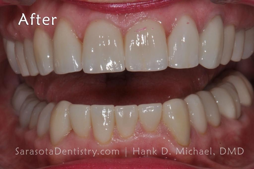 Porcelain Crown Smile Makeover #2 — view 3