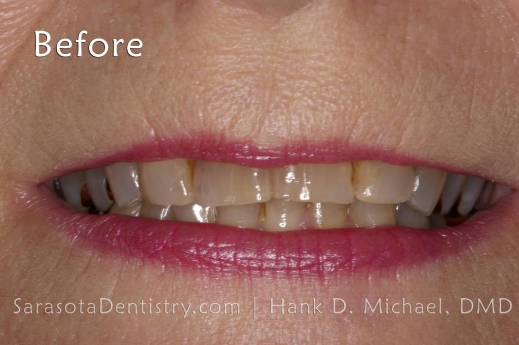 Porcelain Crown Smile Makeover #2 — view 5