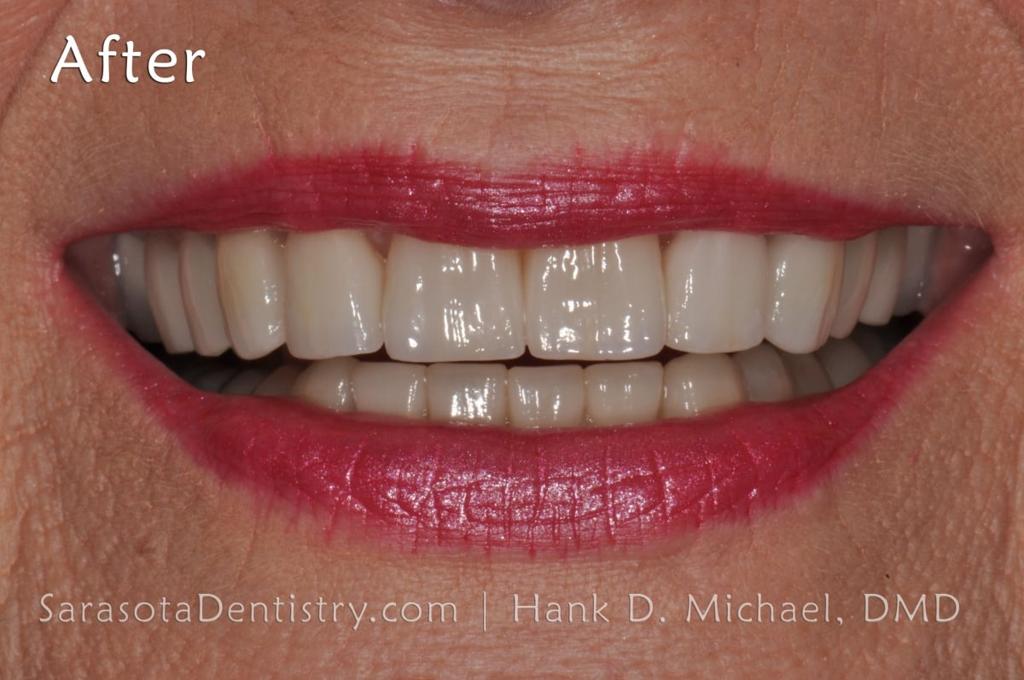 Porcelain Crown Smile Makeover #2 — view 6