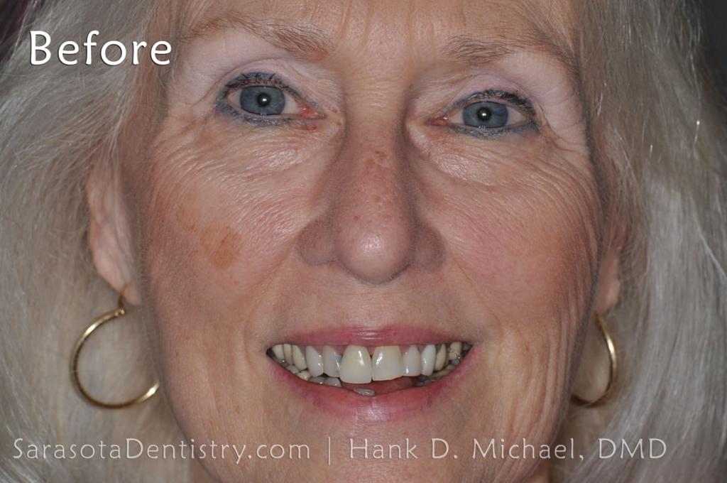 CEREC Same Day Crowns & Bridge — view 2