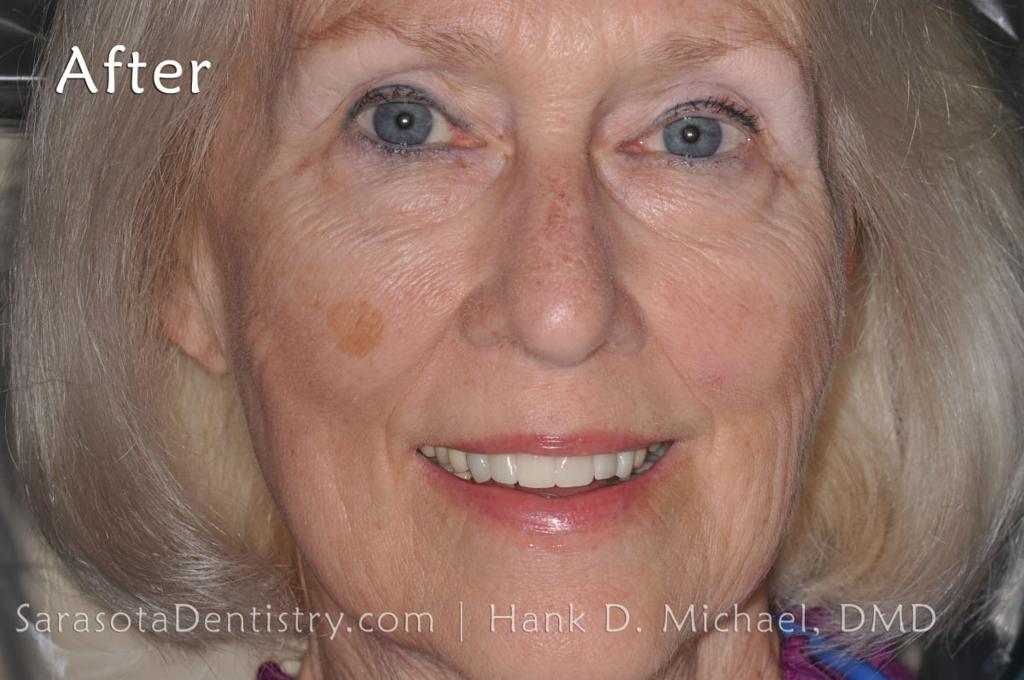 CEREC Same Day Crowns & Bridge