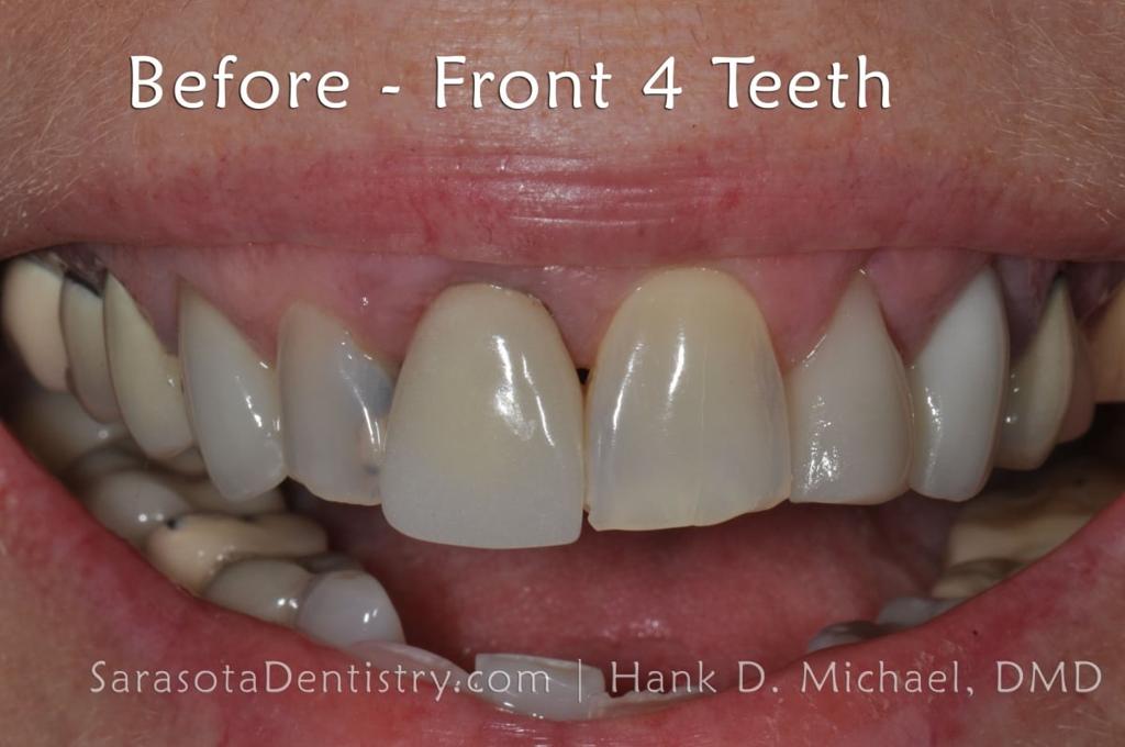 CEREC Same Day Crowns & Bridge — view 4