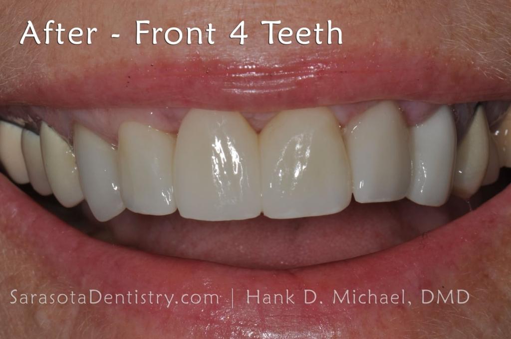 CEREC Same Day Crowns & Bridge — view 3