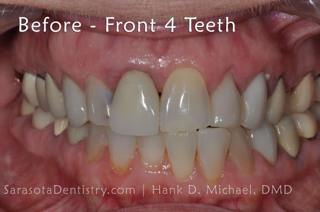 CEREC Same Day Crowns & Bridge — view 6