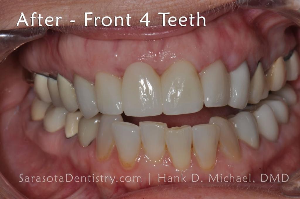 CEREC Same Day Crowns & Bridge — view 5