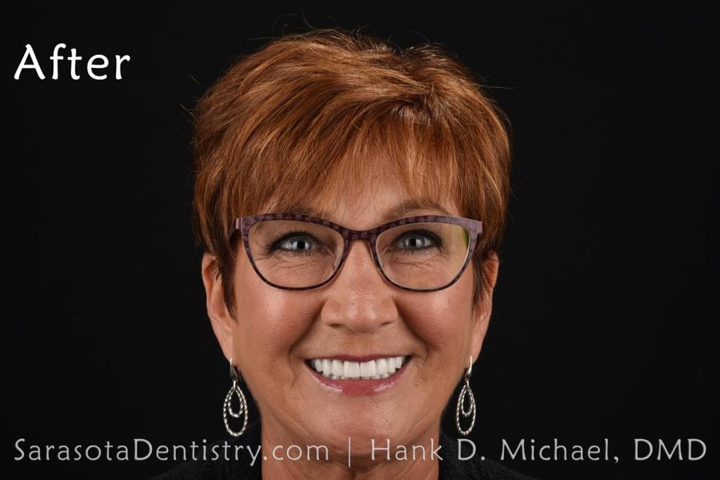 Amazing Porcelain to Zirconia Smile Makeover