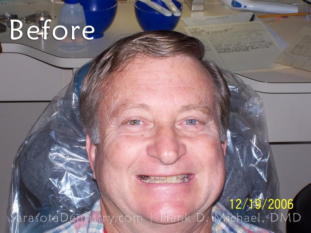 Extreme Smile Makeover with Porcelain Crowns — view 2
