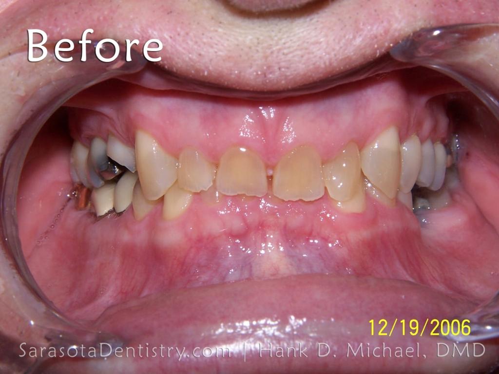 Extreme Smile Makeover with Porcelain Crowns — view 6