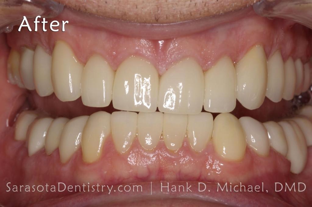 Extreme Smile Makeover with Porcelain Crowns — view 5
