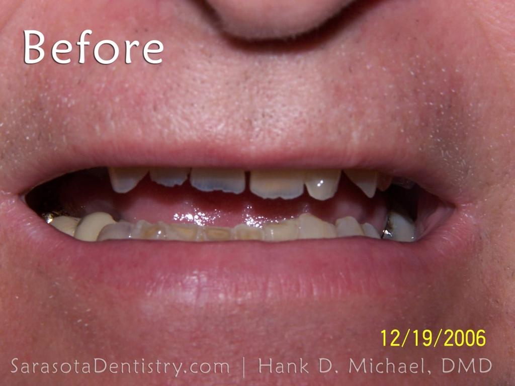 Extreme Smile Makeover with Porcelain Crowns — view 4
