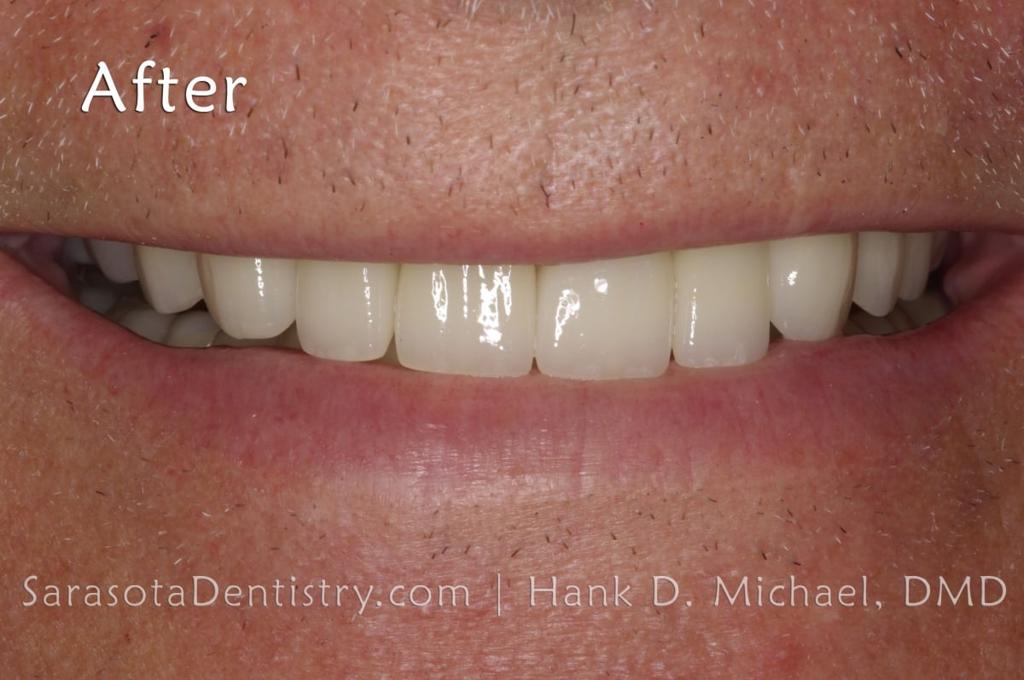Extreme Smile Makeover with Porcelain Crowns — view 3