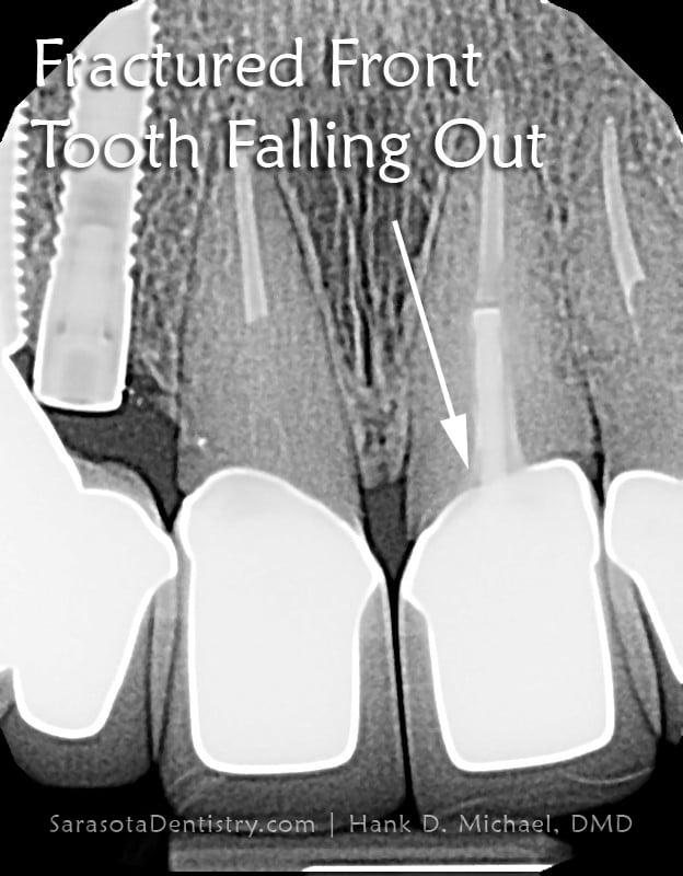 Front Tooth Replacement: Same Day Dental Implant in 1 Hour