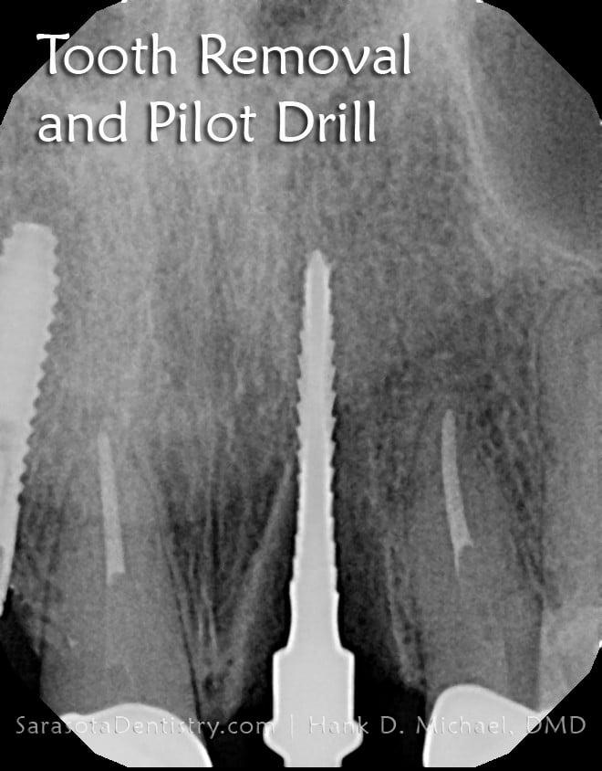 Front Tooth Replacement: Same Day Dental Implant in 1 Hour — view 2