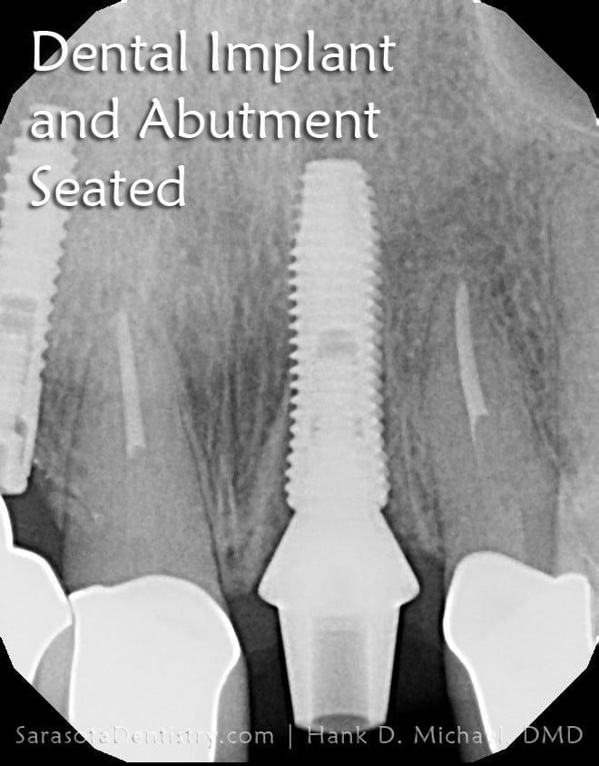 Front Tooth Replacement: Same Day Dental Implant in 1 Hour — view 3