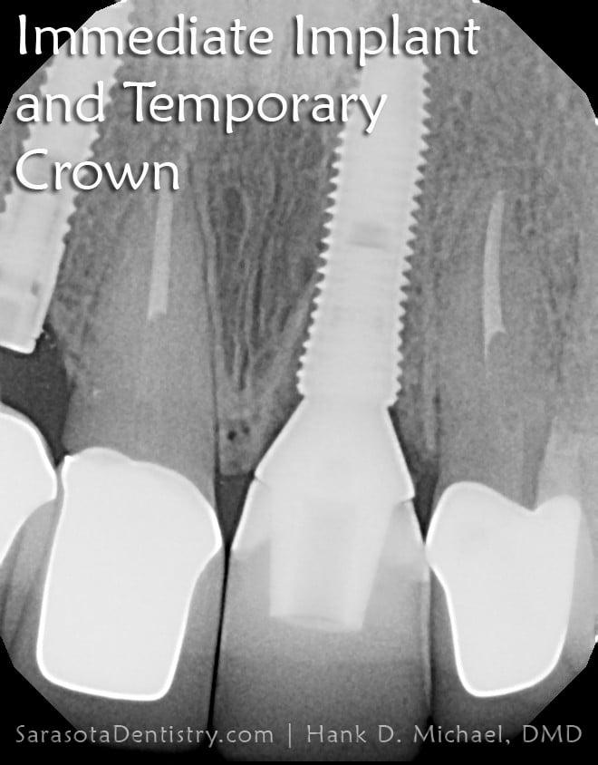 Front Tooth Replacement: Same Day Dental Implant in 1 Hour — view 4