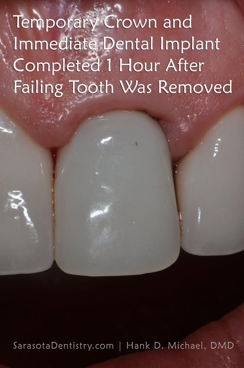 Front Tooth Replacement: Same Day Dental Implant in 1 Hour — view 5