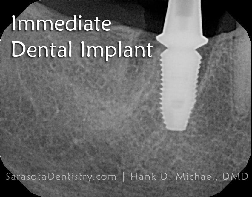 Dental Implant Smile Case 1 — view 2