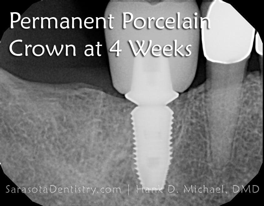 Dental Implant Smile Case 1 — view 3