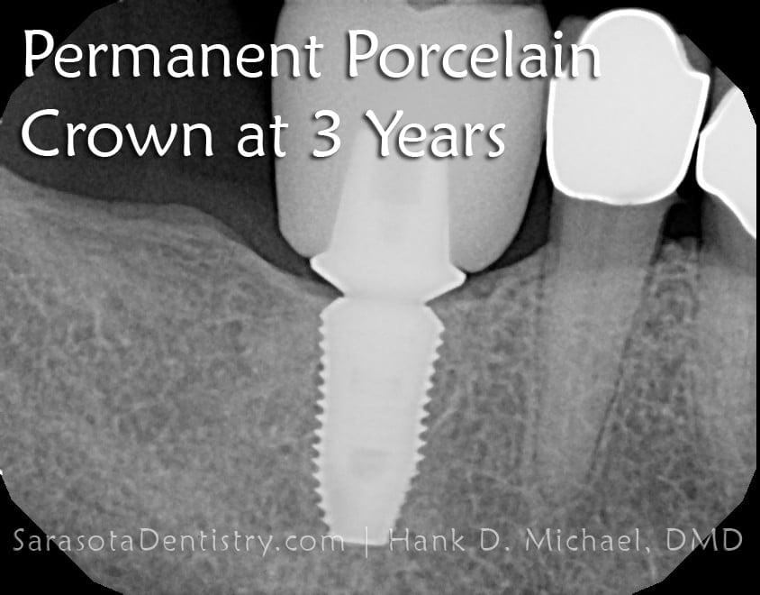 Dental Implant Smile Case 1 — view 4