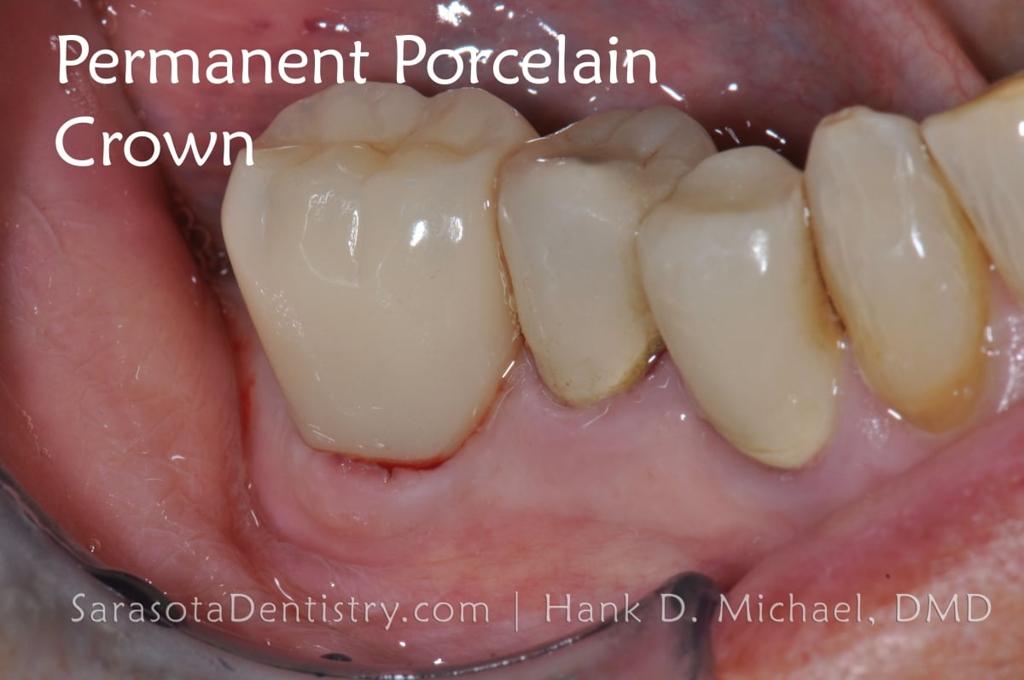 Dental Implant Smile Case 1 — view 5