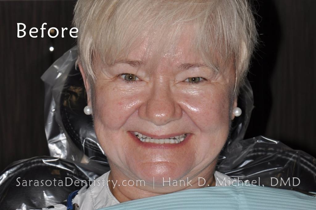 Porcelain to Zirconia Crowns Smile Makeover 20