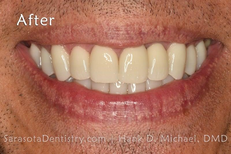 Porcelain Crowns Smile Makeover 21 — view 4