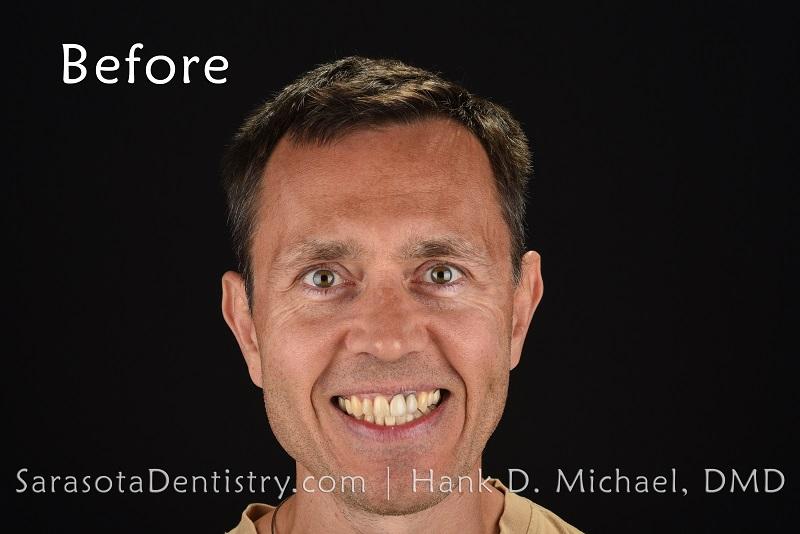 Porcelain Crowns Smile Makeover 21