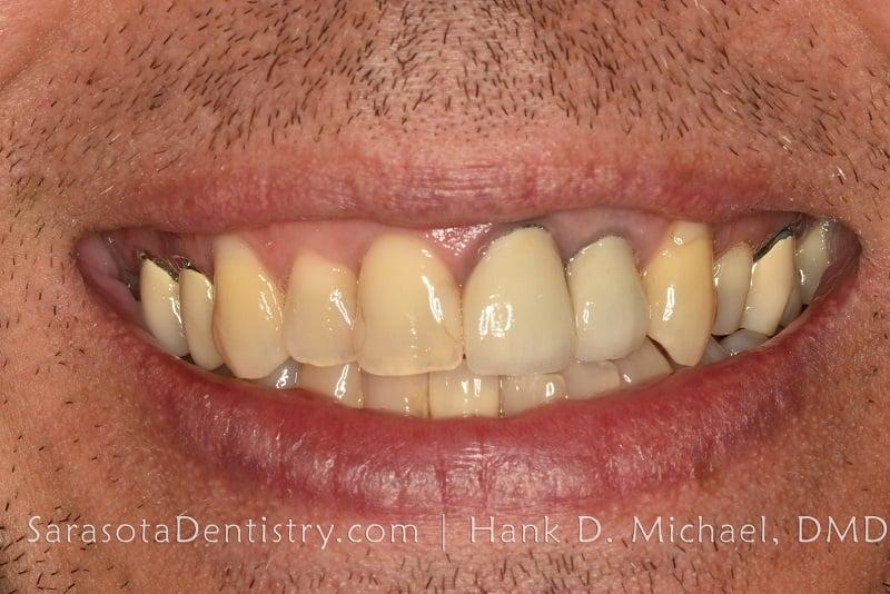 Porcelain Crowns Smile Makeover 21 — view 3