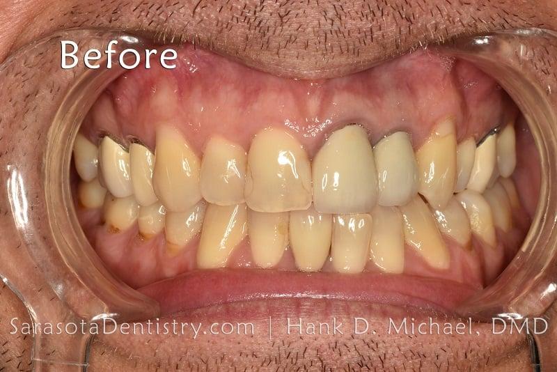 Porcelain Crowns Smile Makeover 21 — view 5