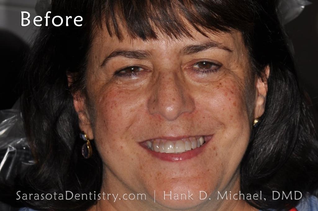 Smile Makeover with Porcelain Crowns & Caps