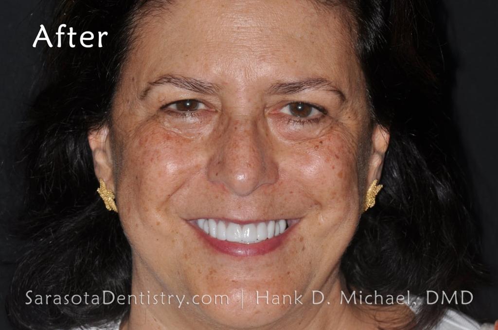 Smile Makeover with Porcelain Crowns & Caps — view 2