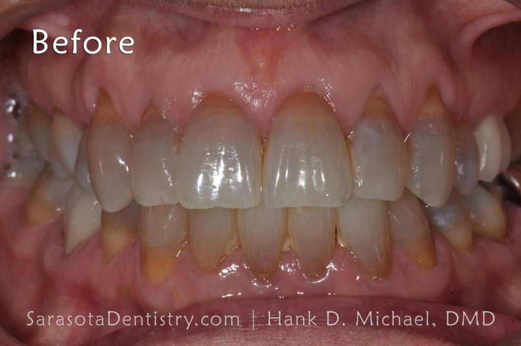 Smile Makeover with Porcelain Crowns & Caps — view 3
