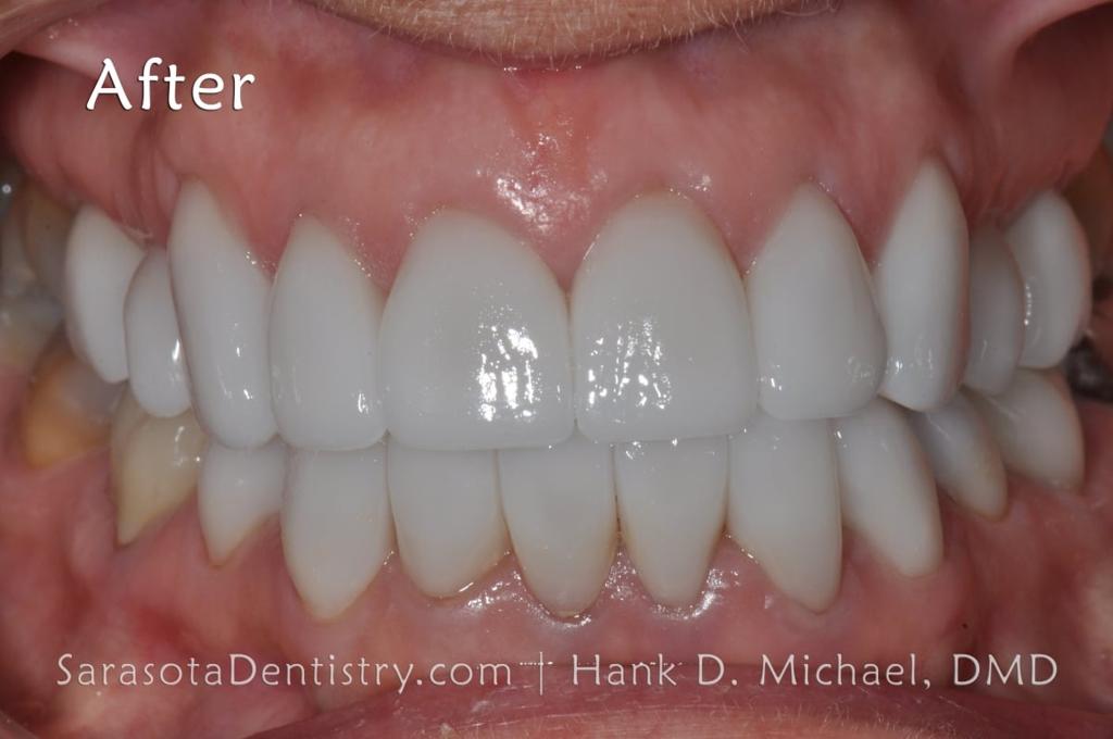 Smile Makeover with Porcelain Crowns & Caps — view 4