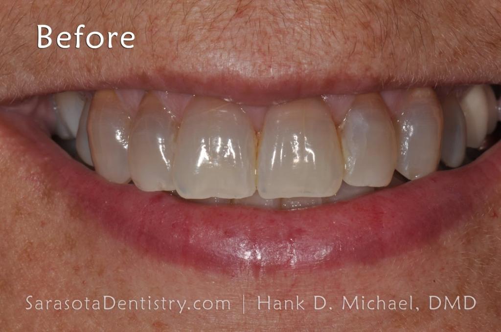 Smile Makeover with Porcelain Crowns & Caps — view 5