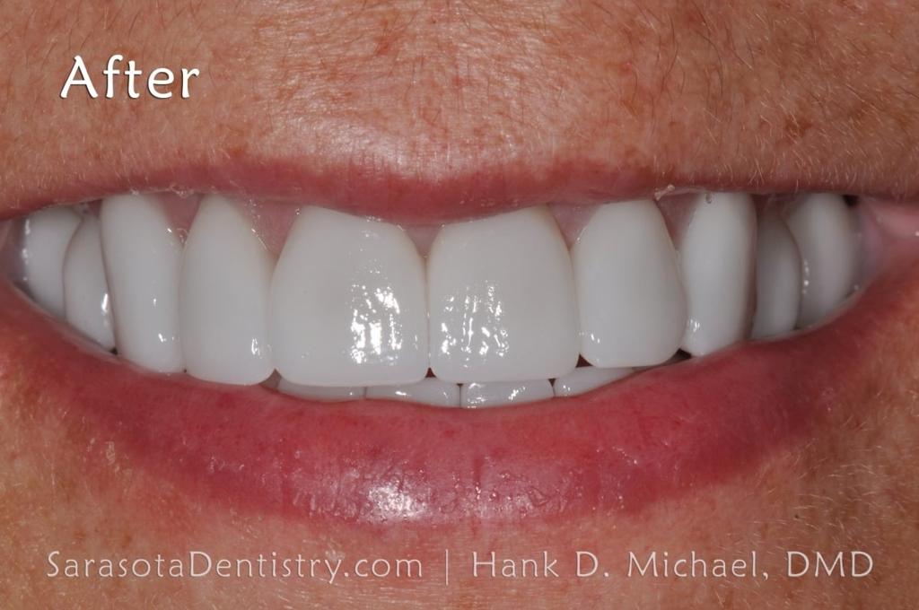 Smile Makeover with Porcelain Crowns & Caps — view 6