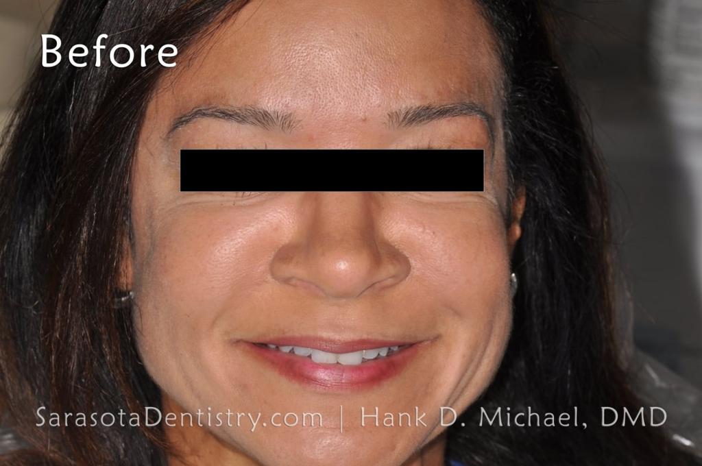 Smile Makeover with Porcelain CEREC Crowns — view 1