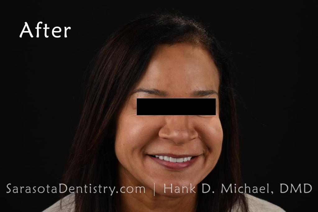 Smile Makeover with Porcelain CEREC Crowns — view 2