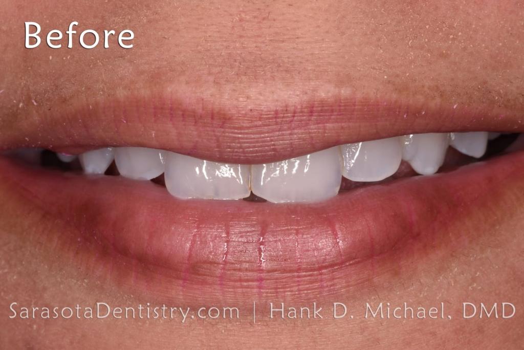 Smile Makeover with Porcelain CEREC Crowns — view 3