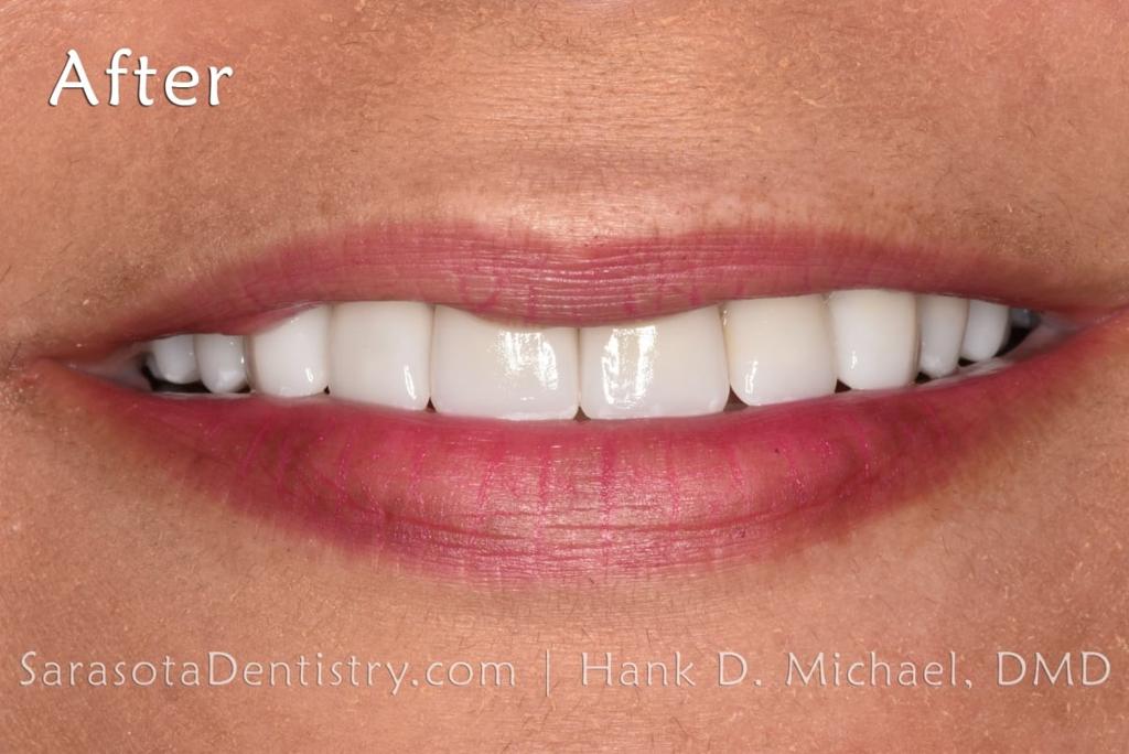 Smile Makeover with Porcelain CEREC Crowns — view 4
