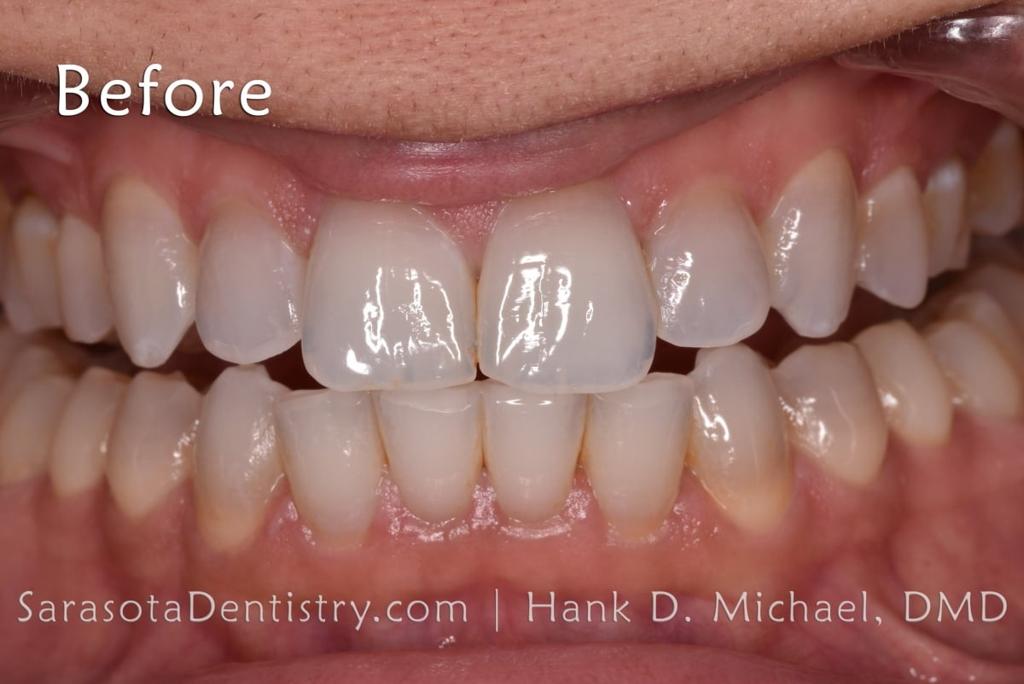 Smile Makeover with Porcelain CEREC Crowns — view 5