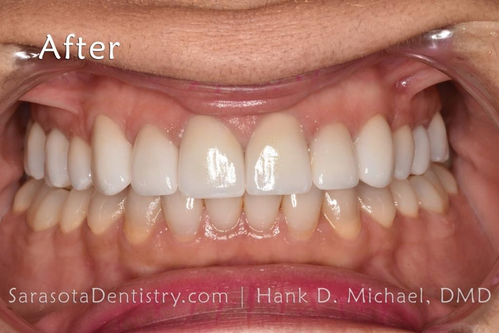 Smile Makeover with Porcelain CEREC Crowns — view 6