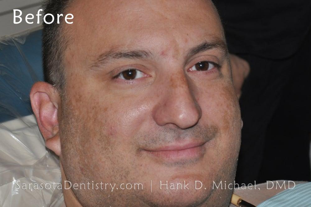 Gap in Front Teeth? Porcelain Crowns are the Solution